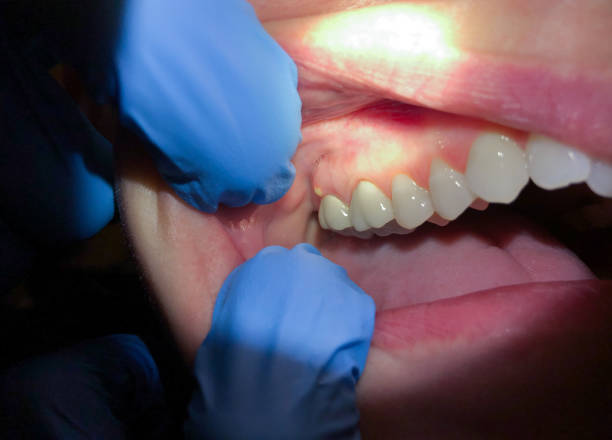 Best Emergency Gum Treatment in North Lynnwood, WA